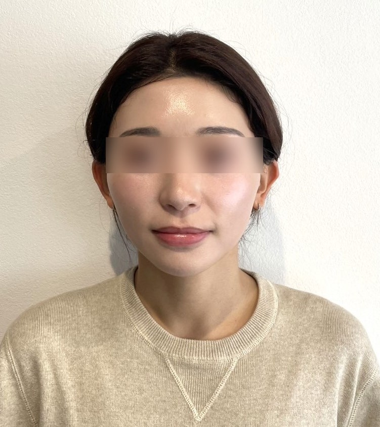 Gangnam Station Thread Lift Specialist: Peanut-Shaped Face – Should You Decide Based Solely on Before & After Photos? Sw
