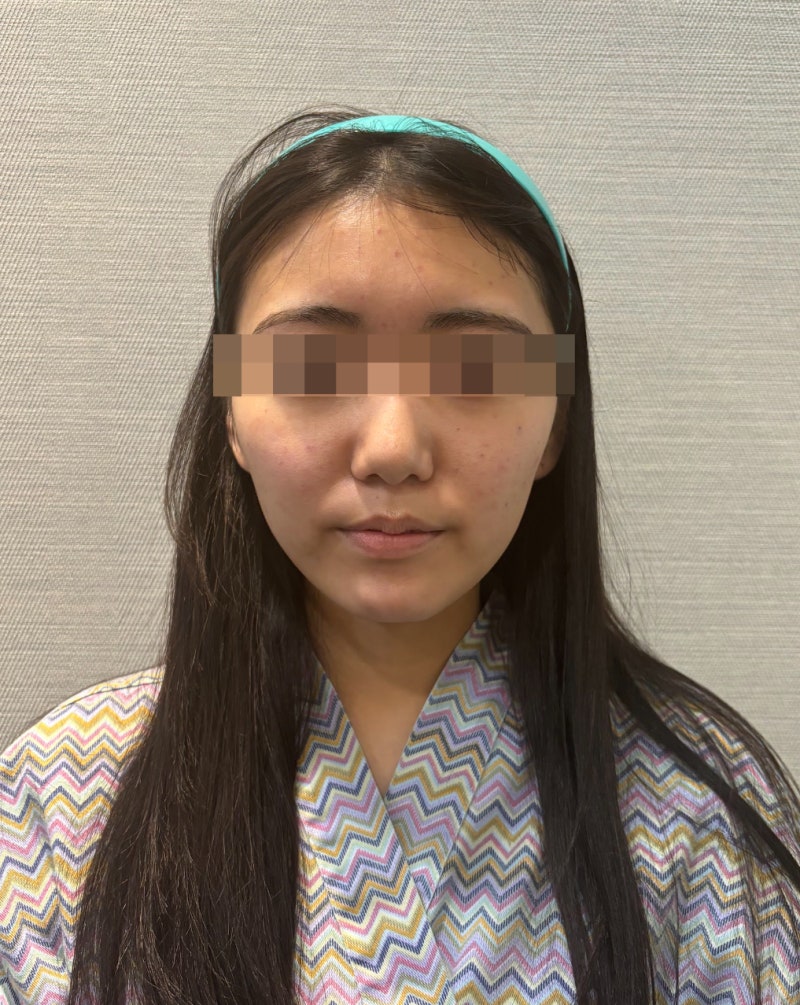Gangnam Thread Lift Recommendation: Do Dissolvable Threads Really Work for Jawline, Contours, and Nasolabial Folds? 사진 5