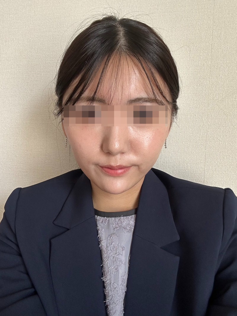 Gangnam Thread Lift Recommendation: Do Dissolvable Threads Really Work for Jawline, Contours, and Nasolabial Folds? 사진 6