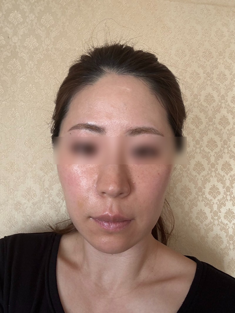 Gangnam Thread Lift Clinic: Why So Many Recommendations? Can It Really Make You Look Younger and Shorten Your Midface? 사