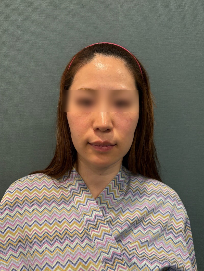 Gangnam Thread Lift Clinic: Why So Many Recommendations? Can It Really Make You Look Younger and Shorten Your Midface? 사