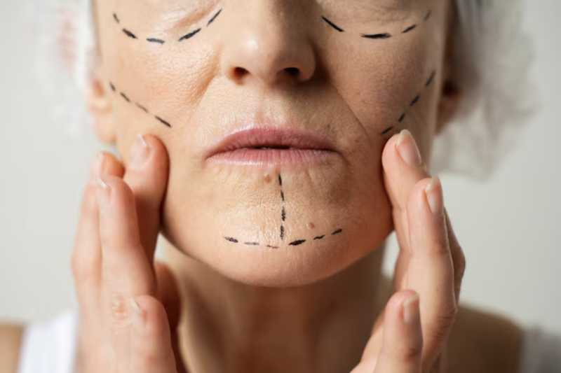 Gangnam Thread Lift Price: If Dimples Appear, Do I Need a Re-procedure? Threads, Swelling, and Bruising