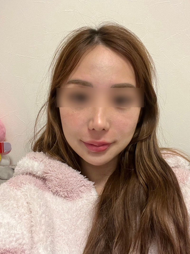 강남잼버실리프팅 vs 일반실, 장점은 무엇이고 붓기는 얼마나 갈까? 사진 5