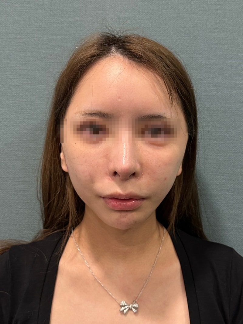잼버실 부작용 자보실·민트실과 다를까? 팔자주름 치료·통증·효과 비교 사진 5