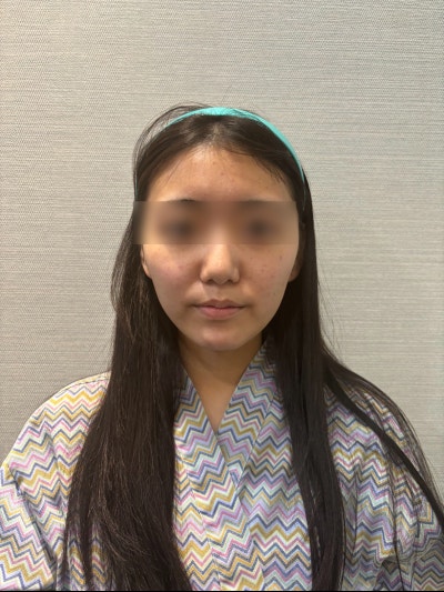 실리프팅 후 붓기 언제까지 정상일까? 원장이 직접 알려주는 회복기간과 부작용 구분법 사진 5