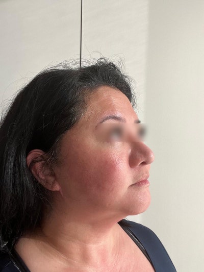 Is This a Facelift Side Effect? Swelling, Cheek Indentation, Scars, Asymmetry, and Numbness: Normal Range and Recovery P