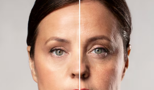 Is Upper Blepharoplasty Necessary for Middle-Aged Individuals? Effects, Costs, and Recovery for Droopy Eyelids and Ptosis