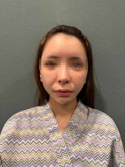 Deep Cheek Thread Lift with Mint Threads: When Does It Go Wrong? Design, Number of Threads, and Real Reviews 사진 9