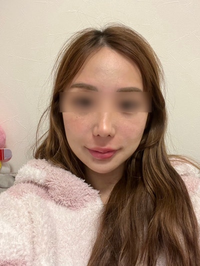 Deep Cheek Thread Lift with Mint Threads: When Does It Go Wrong? Design, Number of Threads, and Real Reviews 사진 12