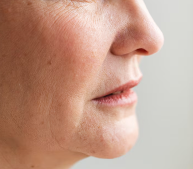Deep Cheek Thread Lift with Mint Threads: When Does It Go Wrong? Design, Number of Threads, and Real Reviews 사진 4