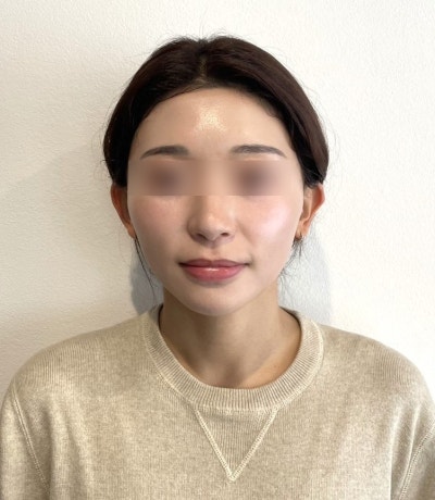 How long does under-eye thread lift swelling last? Duration, side effects, pain, and criteria for a good clinic 사진 9