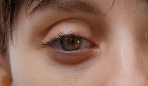 How long does under-eye thread lift swelling last? Duration, side effects, pain, and criteria for a good clinic