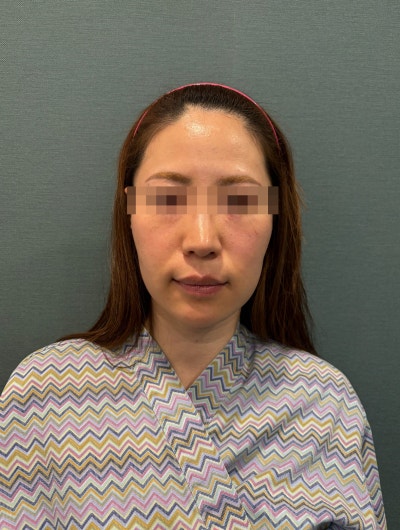 Sejauh Mana Efek Bulldog Sagging Thread Lifting? Ulasan Nyata dan Standar Harga 사진 6