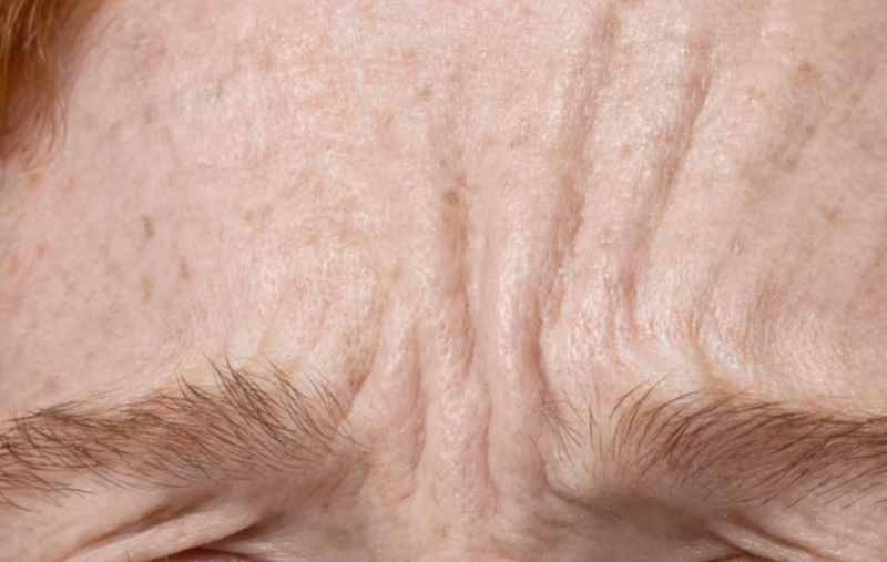 Forehead Thread Lift: Can it Improve Wrinkles and Hollows? Effects, Price, Duration, Pain, and Recommended Types 사진 5
