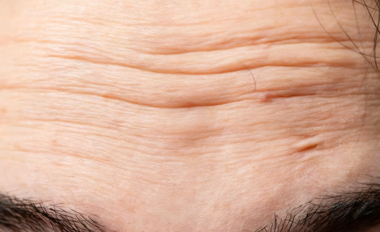 Forehead Thread Lift: Can it Improve Wrinkles and Hollows? Effects, Price, Duration, Pain, and Recommended Types 사진 3