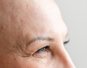 Can Forehead Lift Side Effects Include Headaches, Sunken Eyes, Asymmetry, and Pain? Recovery Process Explained 사진 2