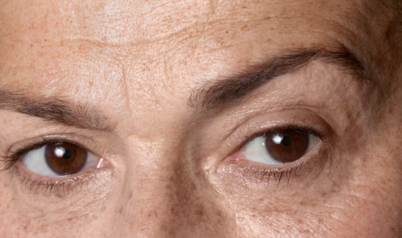 Seoul Forehead Lift: Potential for Headaches and Sensory Abnormalities, and Pre-Surgical Checks for Scar Minimization