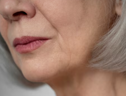 Why Thread Lifts, Not Ultherapy, Are Needed for Sagging Cheeks: A Plastic Surgeon Explains 사진 2