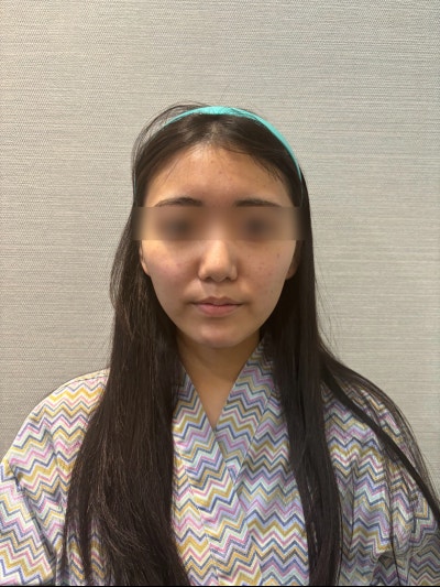 Midface Lift: Before & After, Swelling, Pain, Side Effects, and Cost Explained 사진 7