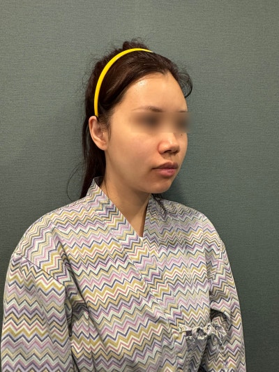 Why do cheekbones appear larger after Mint Thread Lift? Analyzing potential side effects 사진 11