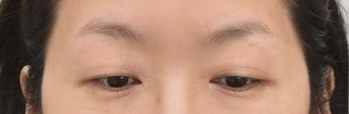 Middle-Aged Droopy Eyelid Surgery: Upper Blepharoplasty vs. Brow Lift – What's the Difference and Cost? 사진 4
