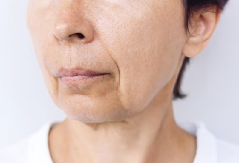Deep Cheek Sagging Thread Lift: Why You Need to Look at the Structure First, Not Just Cheek Fat 사진 2