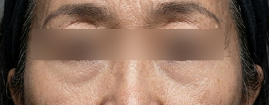 Under-eye Fat Repositioning vs. Lower Blepharoplasty: What's the Difference? Criteria for Sagging & Dark Circles, and Ho