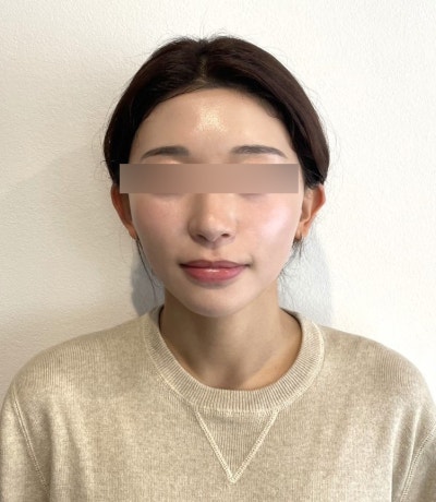 How long does swelling last after a thread lift? Recovery stages, management, and tips for faster reduction 사진 8