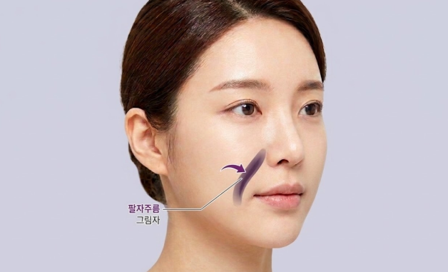 Apakah kerutan nasolabial yang dalam dapat diperbaiki dengan thread lifting? Perbedaan dengan filler, serta kriteria seb
