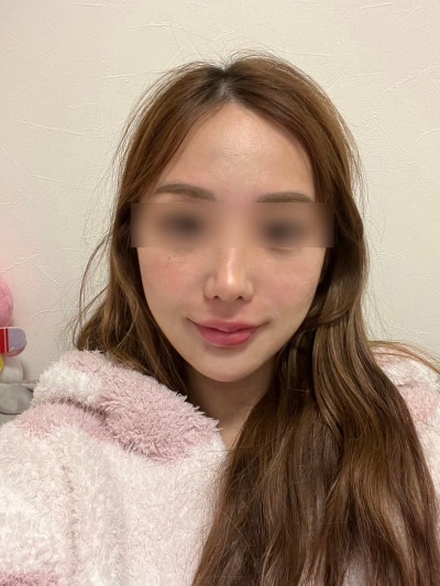 Apakah kerutan nasolabial yang dalam dapat diperbaiki dengan thread lifting? Perbedaan dengan filler, serta kriteria seb