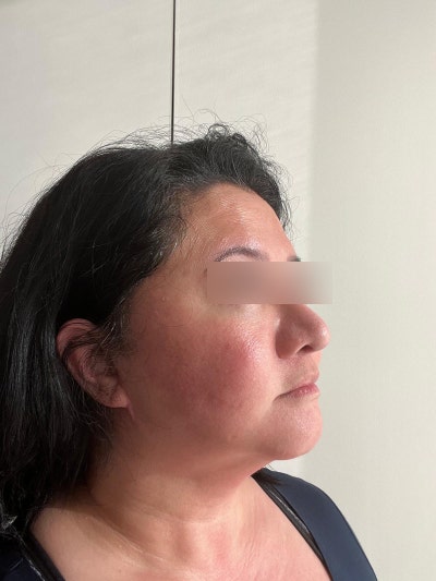 How to Choose a Good Facelift Clinic: Comparing Price, Revision Cases, and Longevity 사진 10