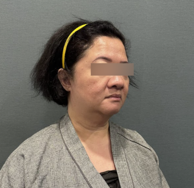 How to Choose a Good Facelift Clinic: Comparing Price, Revision Cases, and Longevity 사진 9