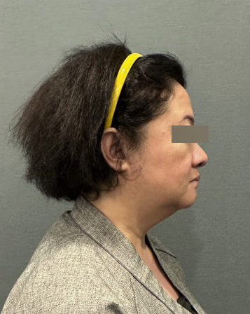 Curious about the effects of a facelift? Here's a summary of post-surgery changes and potential side effects. 사진 6