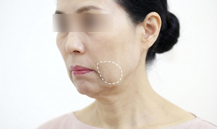 Marionette Lines Treatment: Which Method is Best? Filler, Thread Lift, or Facelift – Understanding the Differences 사진 5