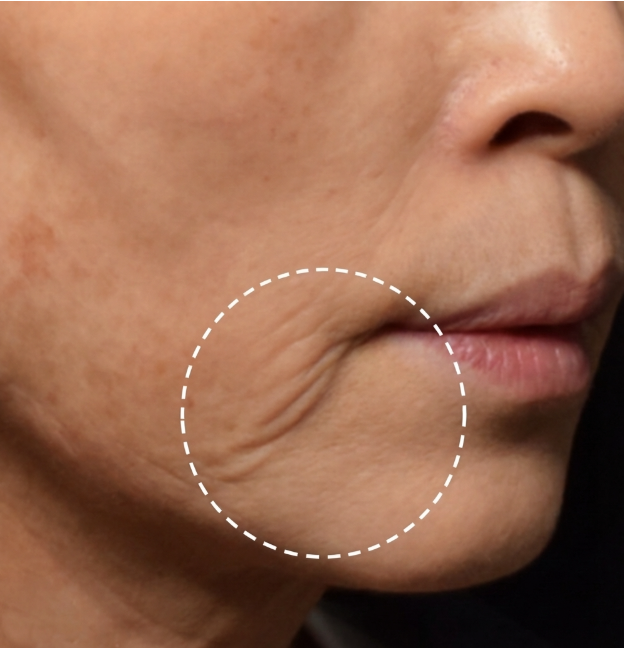Marionette Lines Treatment: Which Method is Best? Filler, Thread Lift, or Facelift – Understanding the Differences 사진 2
