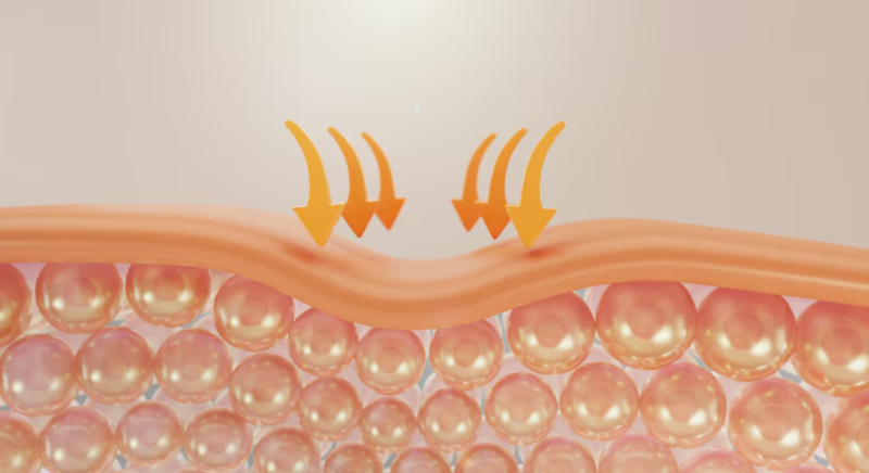 Is a Dimple After Thread Lift Okay? Explaining the Dimple Phenomenon After the Procedure 사진 5