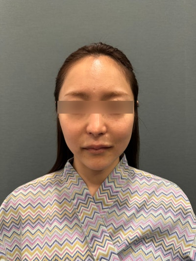 Recommended Anti-Aging Procedures: Lifting Methods for a Naturally Youthful Face 사진 5