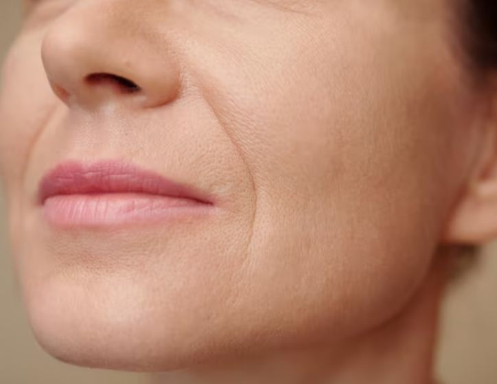 Mini-Ting Thread Lift: When Can It Help? Explaining the Lifting Effect for Sagging Faces 사진 3