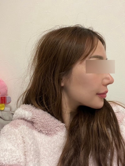 How Much Can Nasolabial Fold Thread Lifts Change Sagging Midface? Explaining the Transformation 사진 3