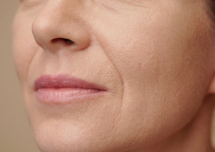 How Much Can Nasolabial Fold Thread Lifts Change Sagging Midface? Explaining the Transformation 사진 8