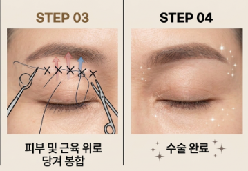 When is a Sub-Brow Lift Needed? The Difference Between Eyebrow Ptosis and Eyelid Ptosis, Explained by the Director 사진 7