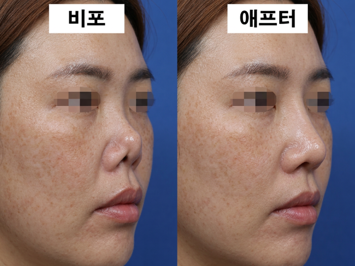 Is Short Nose Revision Surgery Due to Contracted Nose Appearing as a Snub Nose? Cases Requiring Revision Surgery 사진 3