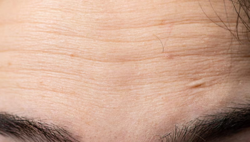 Why Do Eyelids Sag in Your 40s? Understanding the Causes and Improvement Methods