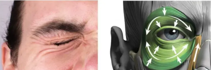 How Much Can a Forehead Lift Change Your Look? Forehead Wrinkle Improvement and Eyebrow Lifting Transformation 사진 5