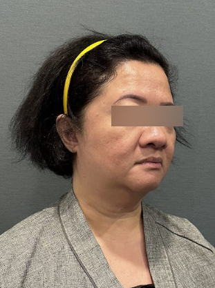 Hal-hal yang Perlu Diketahui Sebelum Konsultasi Perawatan Pasca-Facelift, Periode Pemulihan dan Metode Perawatan 사진 7