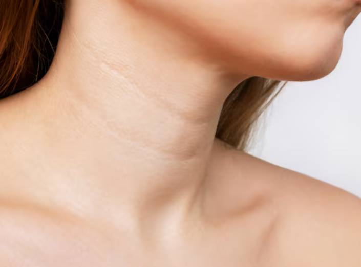 목주름 거상 수술 방법 무엇일까? 펠리컨수술 특징과 목주름 개선 원리 사진 2