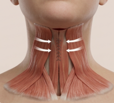 목주름 거상 수술 방법 무엇일까? 펠리컨수술 특징과 목주름 개선 원리 사진 9