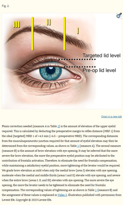 Changes Caused by Neglecting Eyelid Ptosis in Your 60s: Can Upper and Lower Blepharoplasty Help? 사진 7
