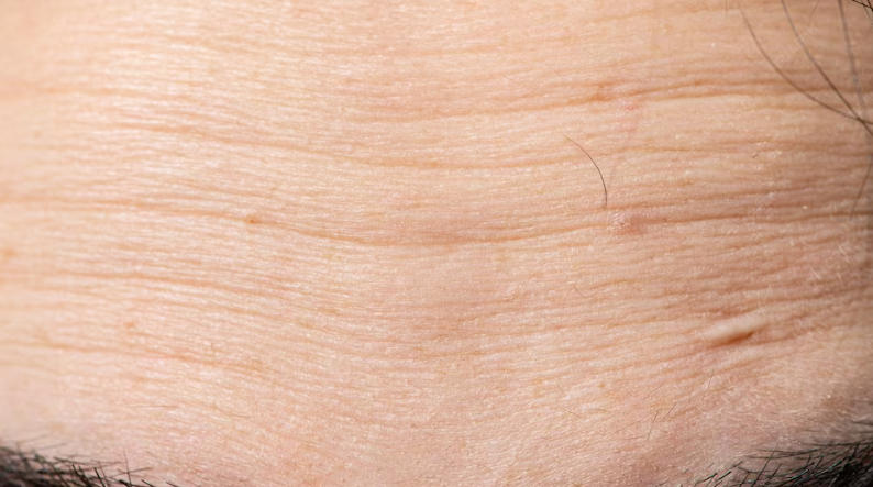 Changes Caused by Neglecting Eyelid Ptosis in Your 60s: Can Upper and Lower Blepharoplasty Help?