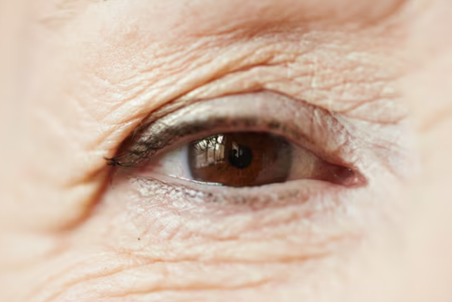 Changes Caused by Neglecting Eyelid Ptosis in Your 60s: Can Upper and Lower Blepharoplasty Help? 사진 5